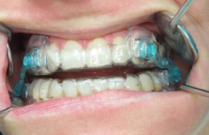 Zahnschienen Kontrolle Zahnarzt